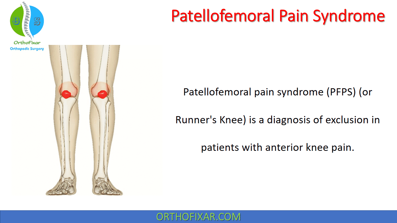  Patellofemoral Pain Syndrome 