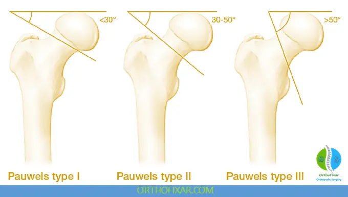 Pauwels Classification