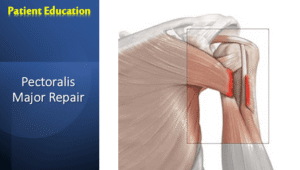 Pectoralis Major Repair: What Patients Need to Know