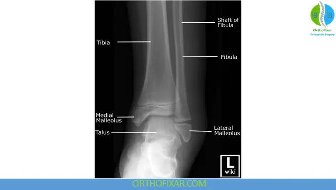 Pediatric Ankle X-Ray