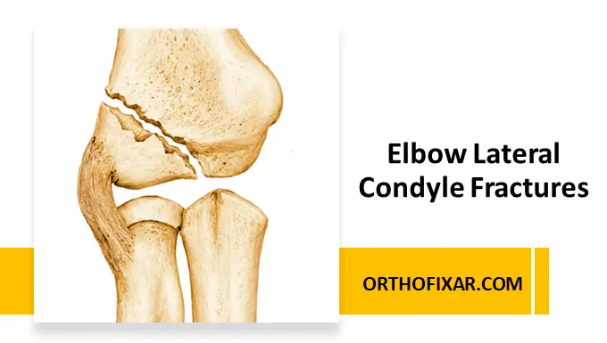 Pediatric Elbow - Lateral Condyle Fractures