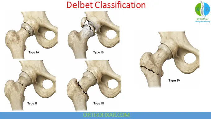 Pediatric Hip Fracture Delbet classification