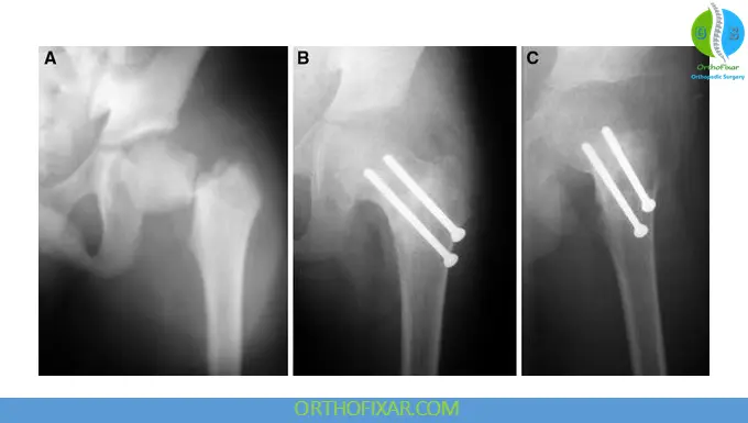 Pediatric Hip Fracture fixation