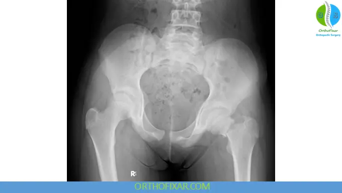 Pediatric Hip Fracture xray