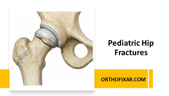 Pediatric Hip Fractures