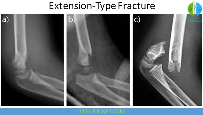 Pediatric Supracondylar Humerus Fractures Extension-Type Fractures