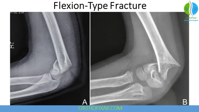Pediatric Supracondylar Humerus Fractures Flexion-Type Fractures