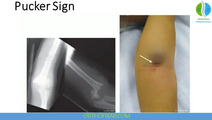 Pediatric Supracondylar Humerus Fractures Pucker Sign