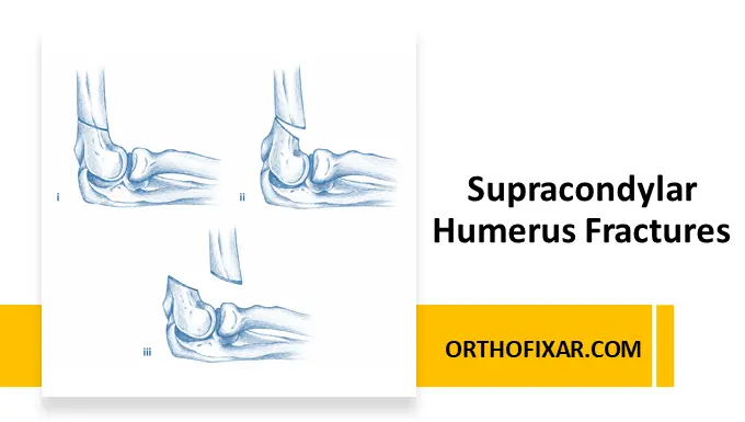 Pediatric Supracondylar Humerus Fractures