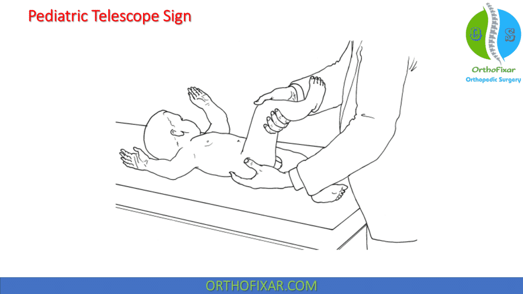Pediatric Telescope Sign