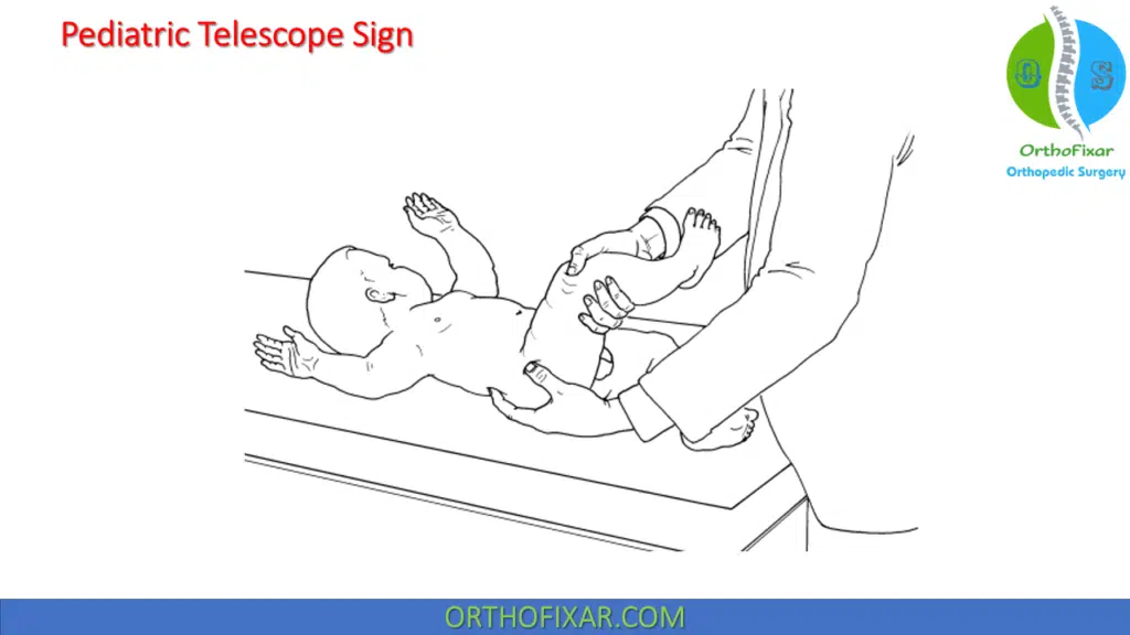 Pediatric Telescope Sign