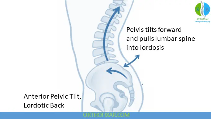Pelvic Angle and Lumbar Lordosis