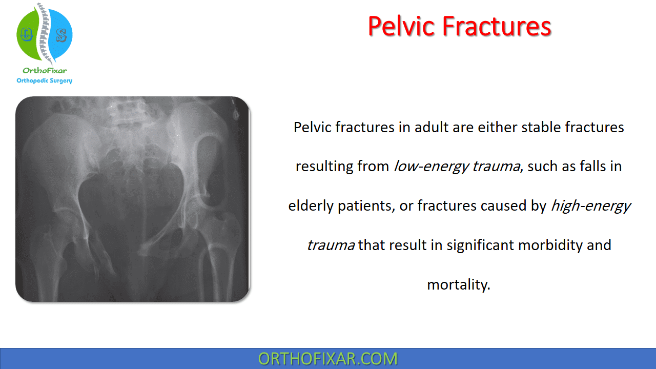 What are the different types of pelvic fracture?