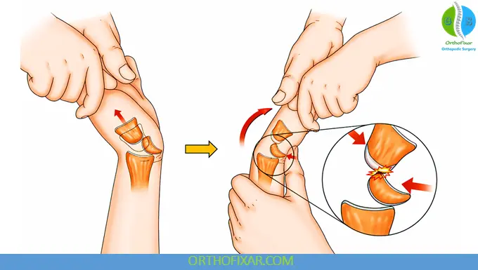 Perilunate Dislocation reduction