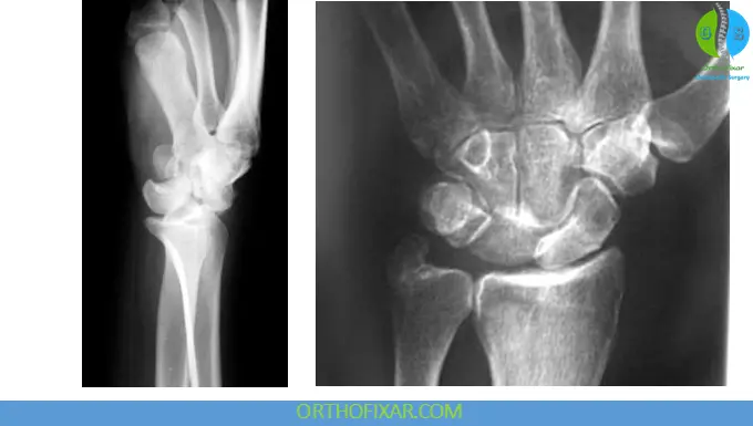 Perilunate Dislocation xray
