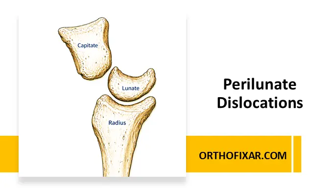 Perilunate Dislocations