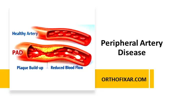 Peripheral Artery Disease (PAD) Symptoms, Causes & Treatment