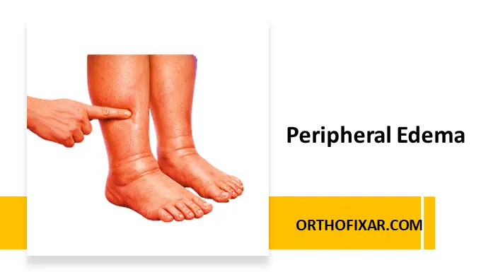 Peripheral Edema