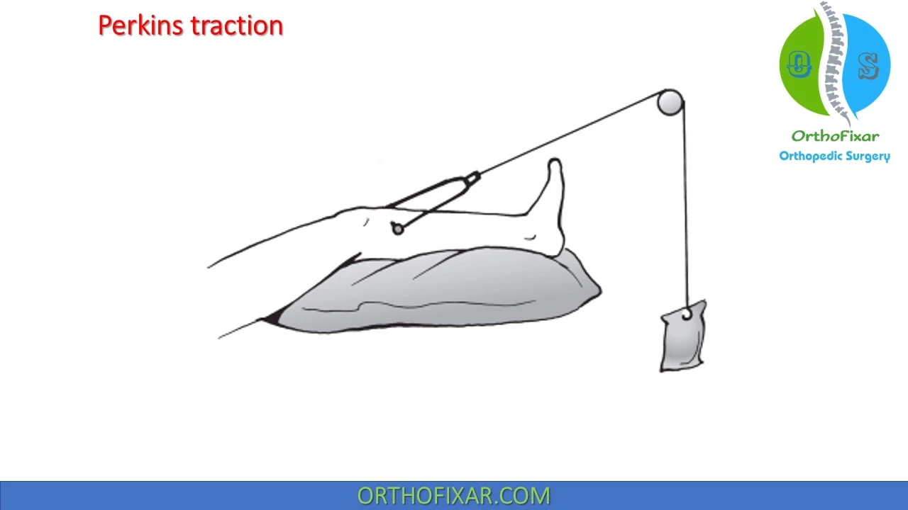 Skeletal Traction Types & Indications