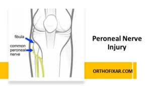 Peroneal Nerve Injury
