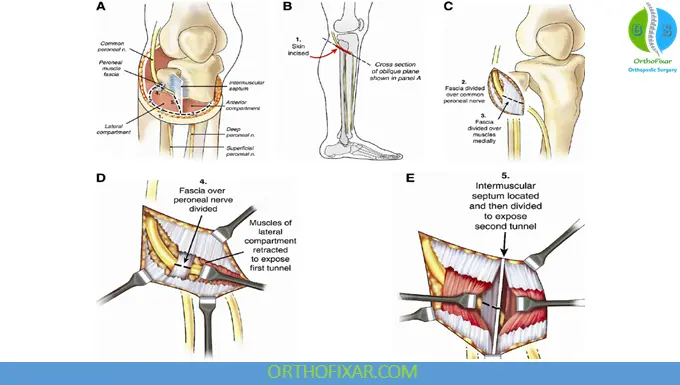 Peroneal Nerve Injury nerve decompression