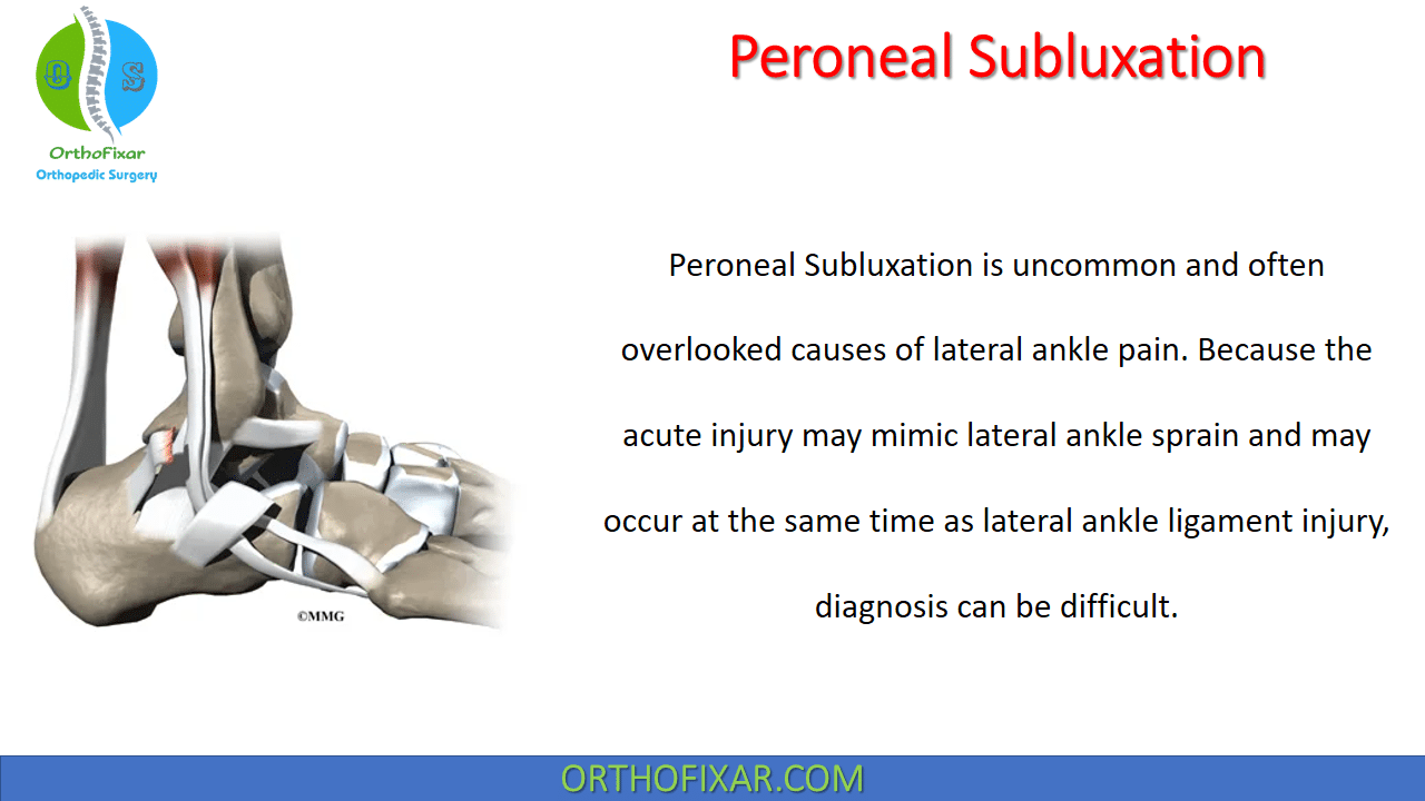 Peroneal Subluxation