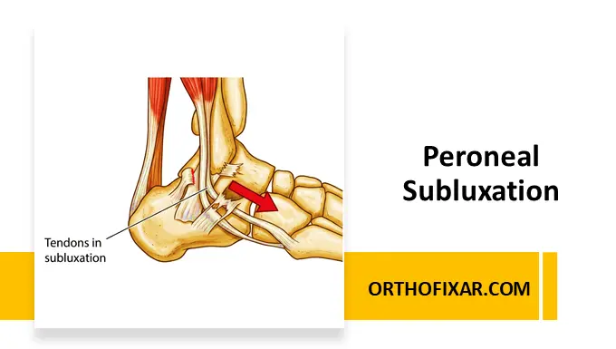 Peroneal Subluxation