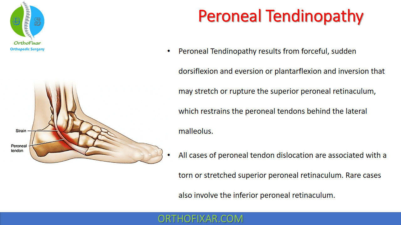 Peroneal Tendinopathy