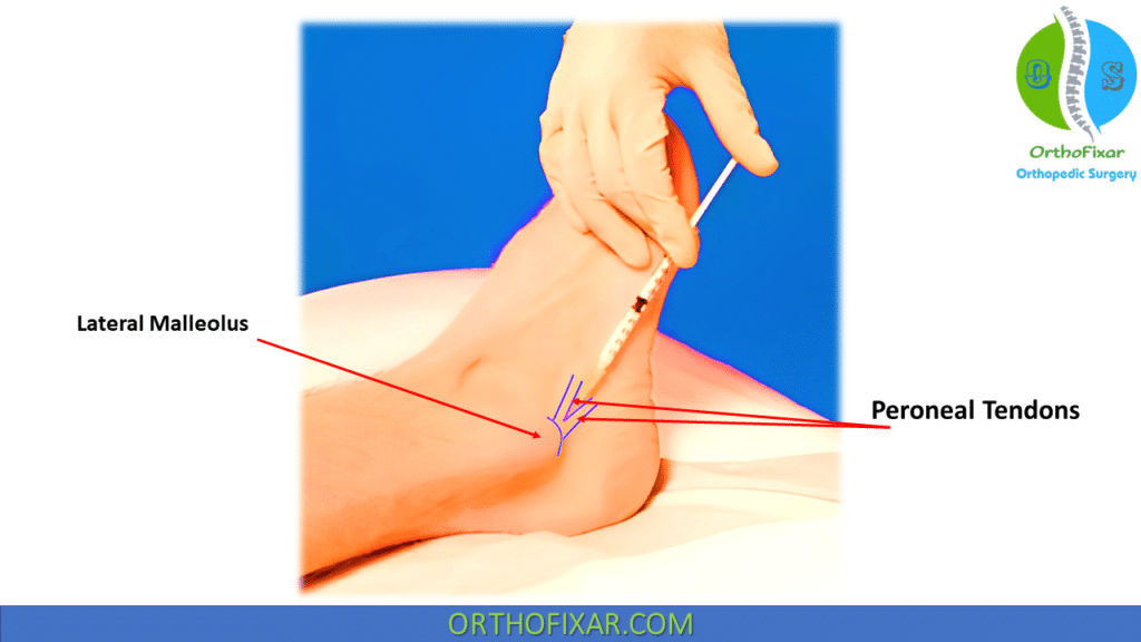Peroneal Tendon Injection Technique