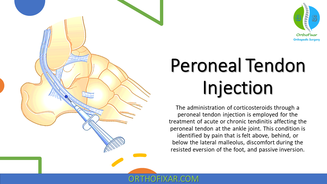 Peroneal Tendon Injection Corticosteroid Technique For Tendinitis Peroneal Tendon Injection Corticosteroid Technique For Tendinitis