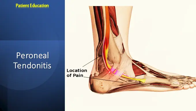 Peroneal Tendonitis