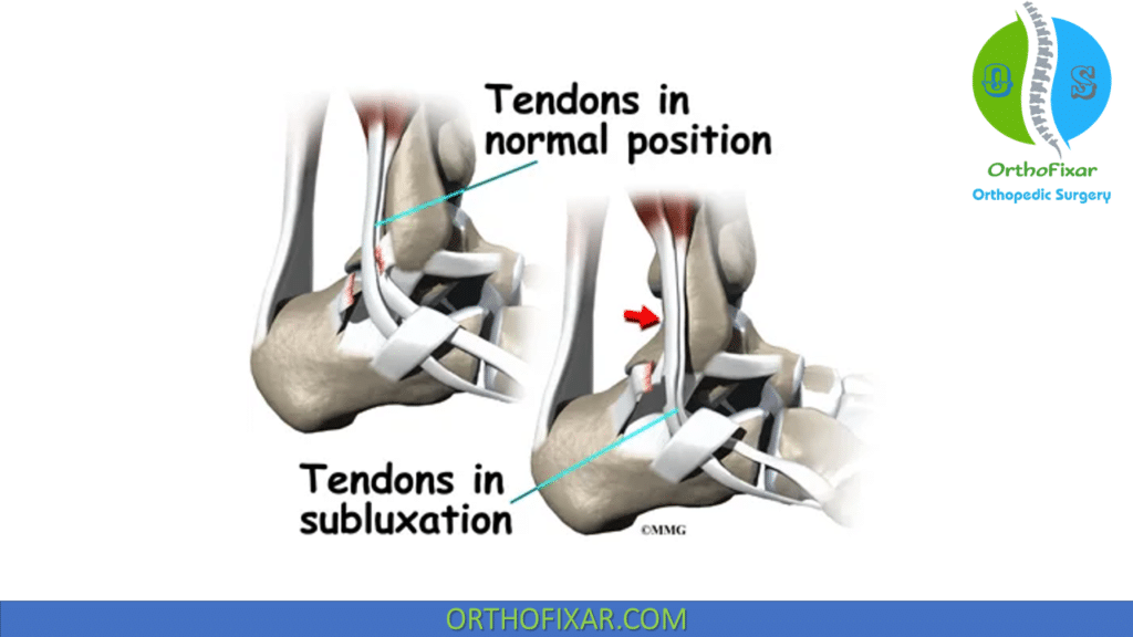 Peroneal tendon Subluxation
