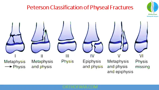 The 5 Salter Harris Fracture Types: Pediatric Physeal Injuries 18 Peterson Classification of Physeal Fractures