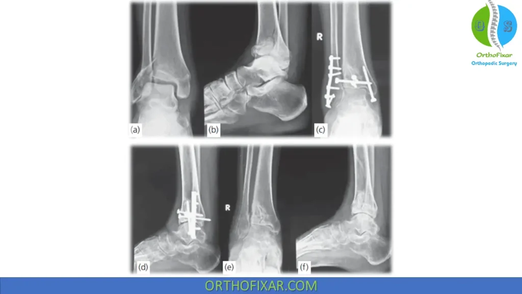 Pilon Fractures Treatment ORIF