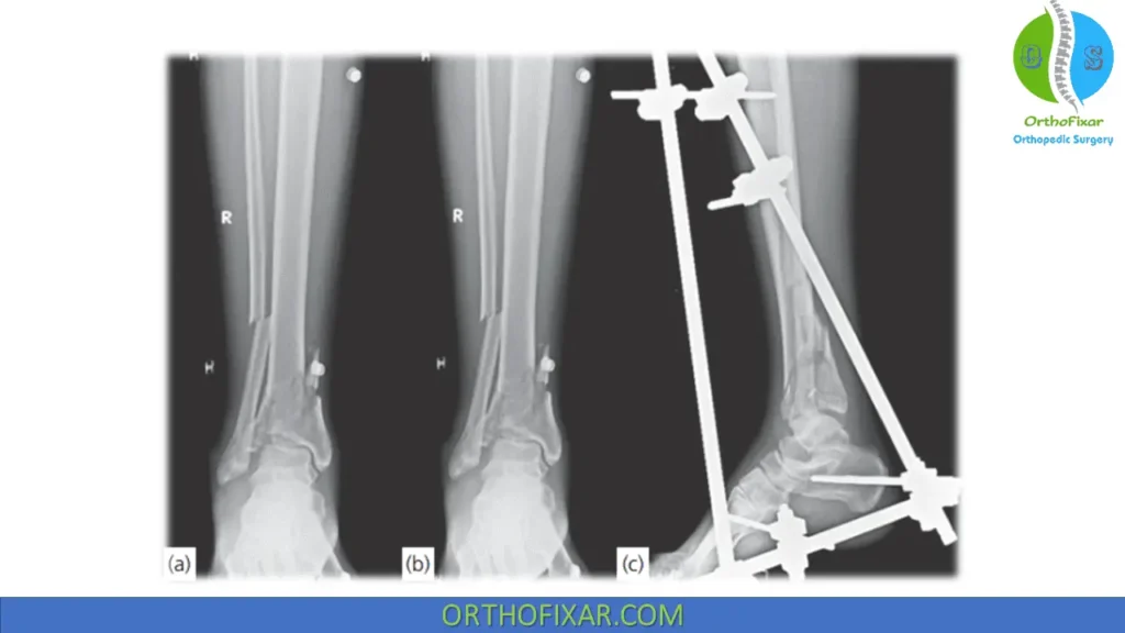 Pilon Fractures Treatment external fixation