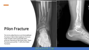 Pilon Fracture | Tibial Plafond Fracture