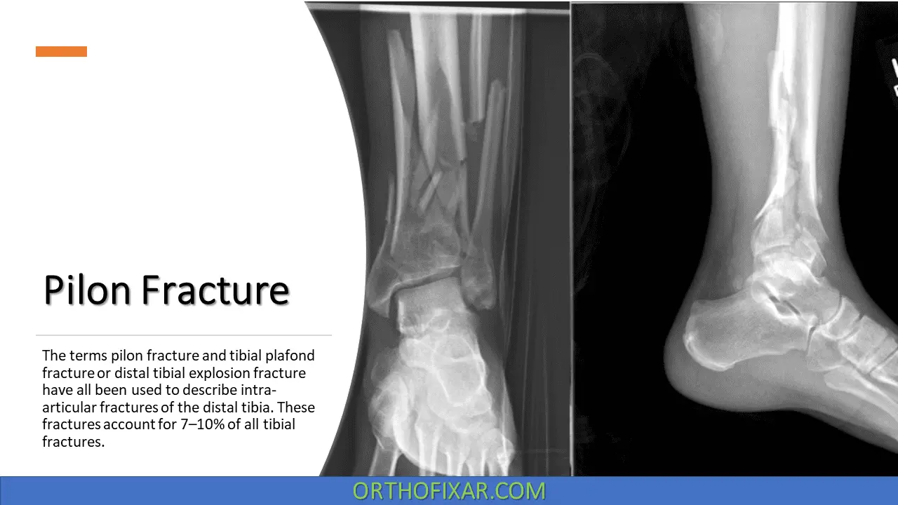 Pilon fractures
