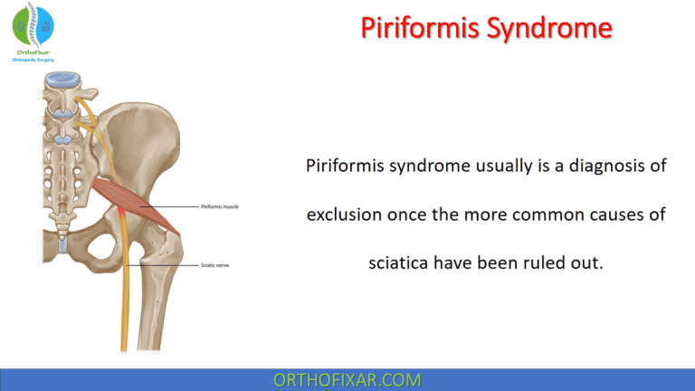 Piriformis Syndrome