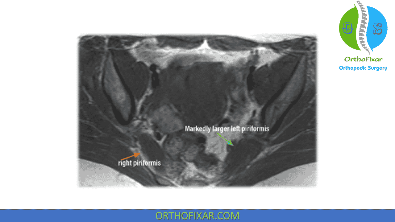 What Is Piriformis Syndrome? - MASS4D® Foot Orthotics