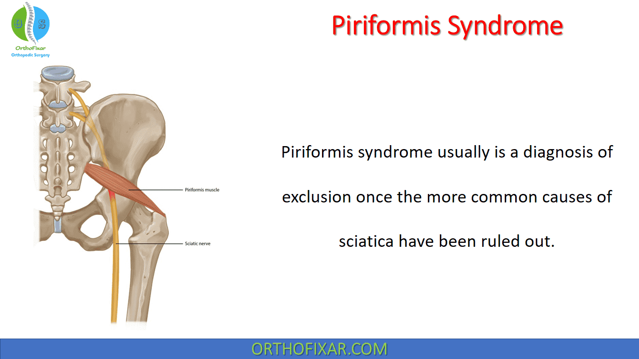  Piriformis Syndrome 