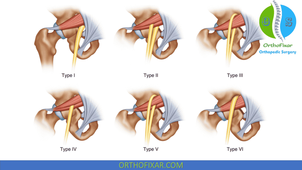 https://orthofixar.com/wp-content/uploads/Piriformis-muscle-variations-1024x576.png