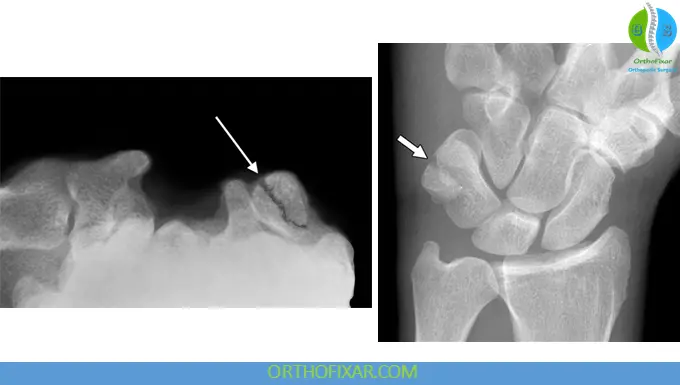 Pisiform Fracture xray