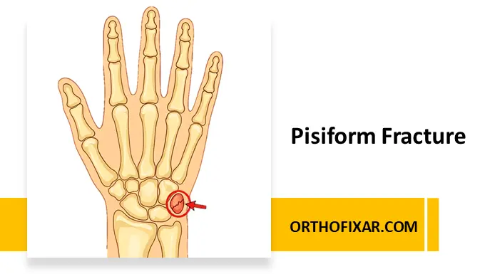 Pisiform Fracture