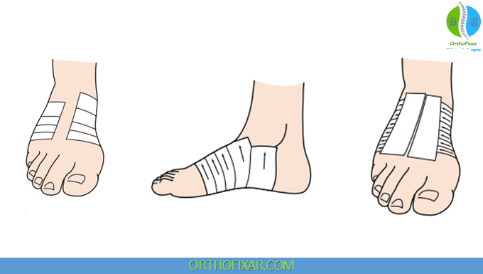 Plantar Fasciitis Taping Technique 6 Plantar Fasciitis Taping 2