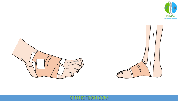 Plantar Fasciitis Taping Technique 7 Plantar Fasciitis Taping 3