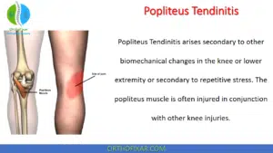 Popliteus Tendinitis