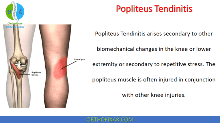Popliteus Tendinitis
