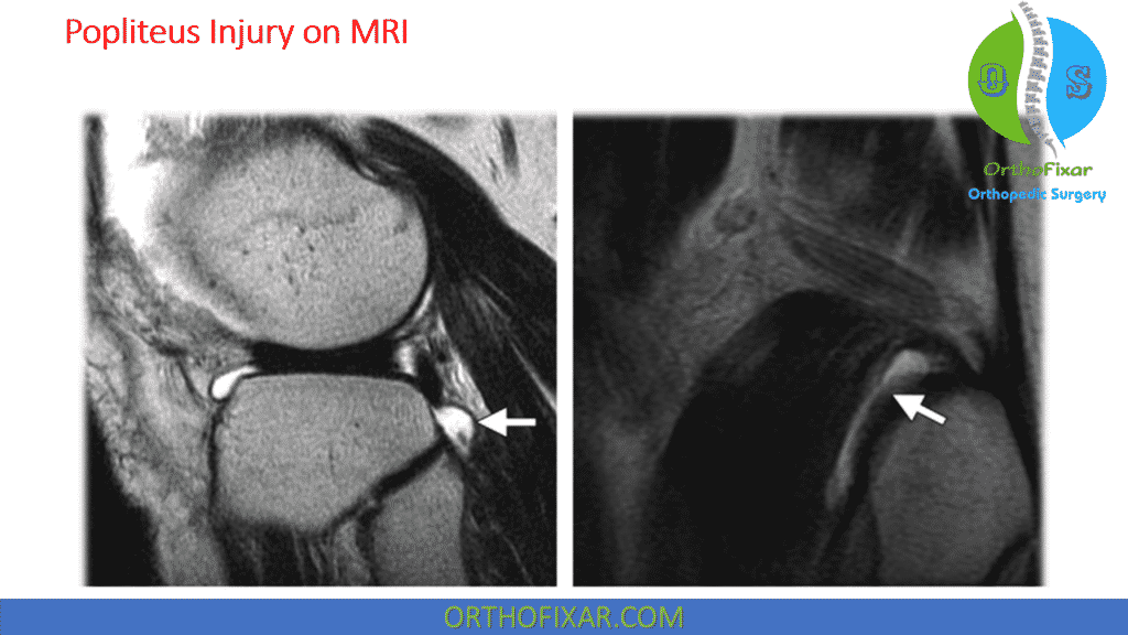 Popliteus injury MRI