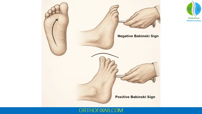 Positive and negative Babinski Sign