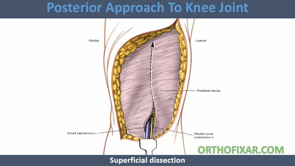Posterior Approach To Knee Joint